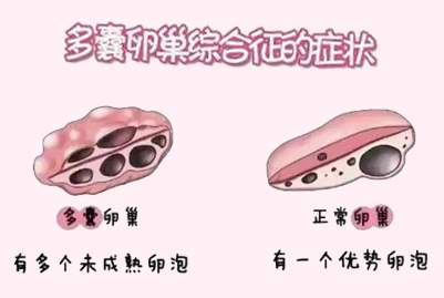几周香港验血胎儿性别,多囊卵巢综合症能否试管技术助孕