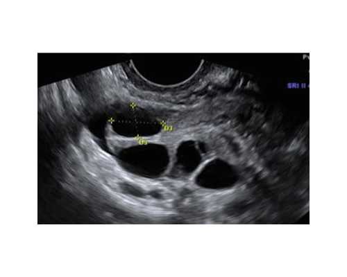 香港验血六周可以_纠结b超还是香港验血_无创dna哪家最权威!