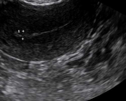 孕14周可以香港验血吗_香港胎儿性别鉴定咨询,验血查男女真的靠谱吗