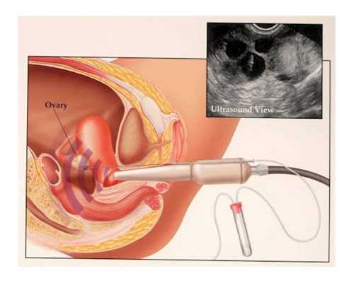 注射泵预置量是什么意思_巨蟹座今生会有遇上什么样的桃花劫情关漫漫
