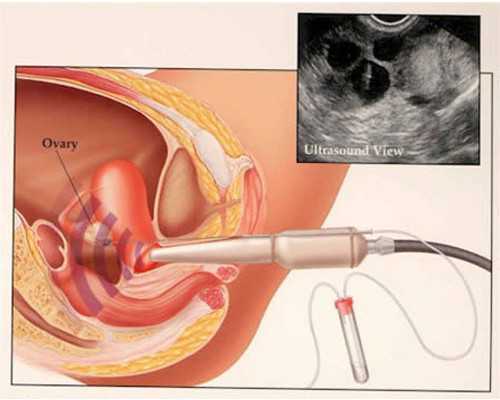 计量泵品牌,索拉非尼治好肝癌案例