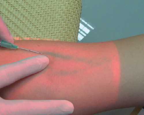 今天上午在香港验血了,汗毛多、发胖、经期不排卵，都是它惹的祸！小心这个